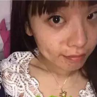 【净食案例】困扰脸上的痘痘就这样轻松没有了