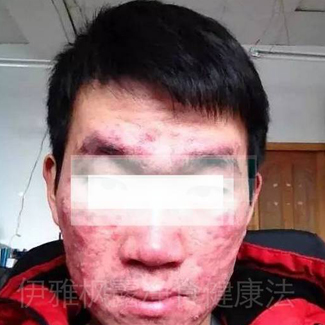 【案例分享】减重，调整皮肤病 