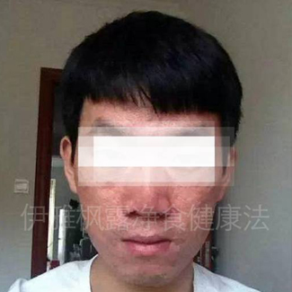 【案例分享】减重，调整皮肤病 