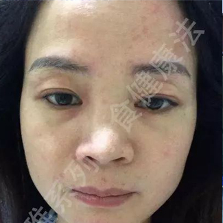 【净食案例】调理荨麻疹，增加抵抗力