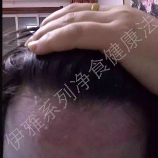 【案例分享】调理牛皮癣、调理体质！