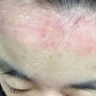 【案例分享】调理牛皮癣、调理体质！