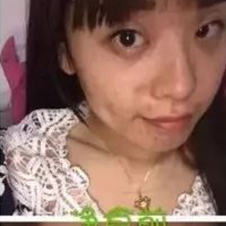 【净食案例】改善痘痘肌