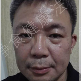 【净食案例】——调理脾胃，降尿酸，降低脂肪肝