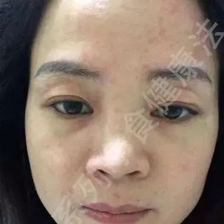 【净食案例】——调理荨麻疹，增加抵抗力